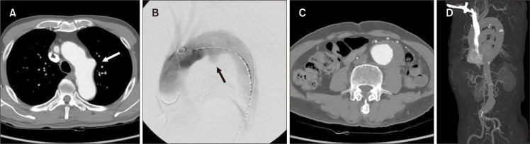 Simultaneous Endovascular Aneurysm Repair for Abdominal Aortic Aneurysm Combined with Saccular Thoracic Aortic Aneurysm.