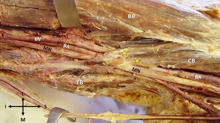 Muscle interconnections in the anterior and posterior arm compartment: a cadaveric case series with possible clinical implications.