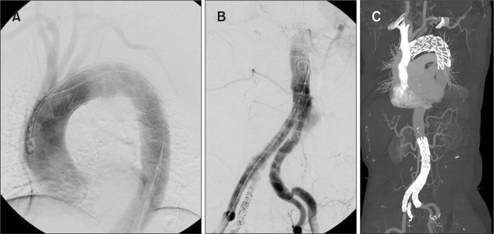 Simultaneous Endovascular Aneurysm Repair for Abdominal Aortic Aneurysm Combined with Saccular Thoracic Aortic Aneurysm.