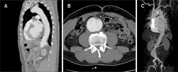 Simultaneous Endovascular Aneurysm Repair for Abdominal Aortic Aneurysm Combined with Saccular Thoracic Aortic Aneurysm.