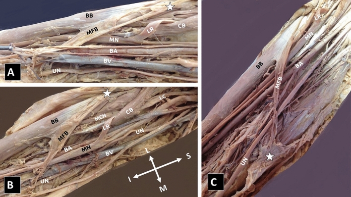 Muscle interconnections in the anterior and posterior arm compartment: a cadaveric case series with possible clinical implications.