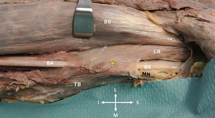 Muscle interconnections in the anterior and posterior arm compartment: a cadaveric case series with possible clinical implications.