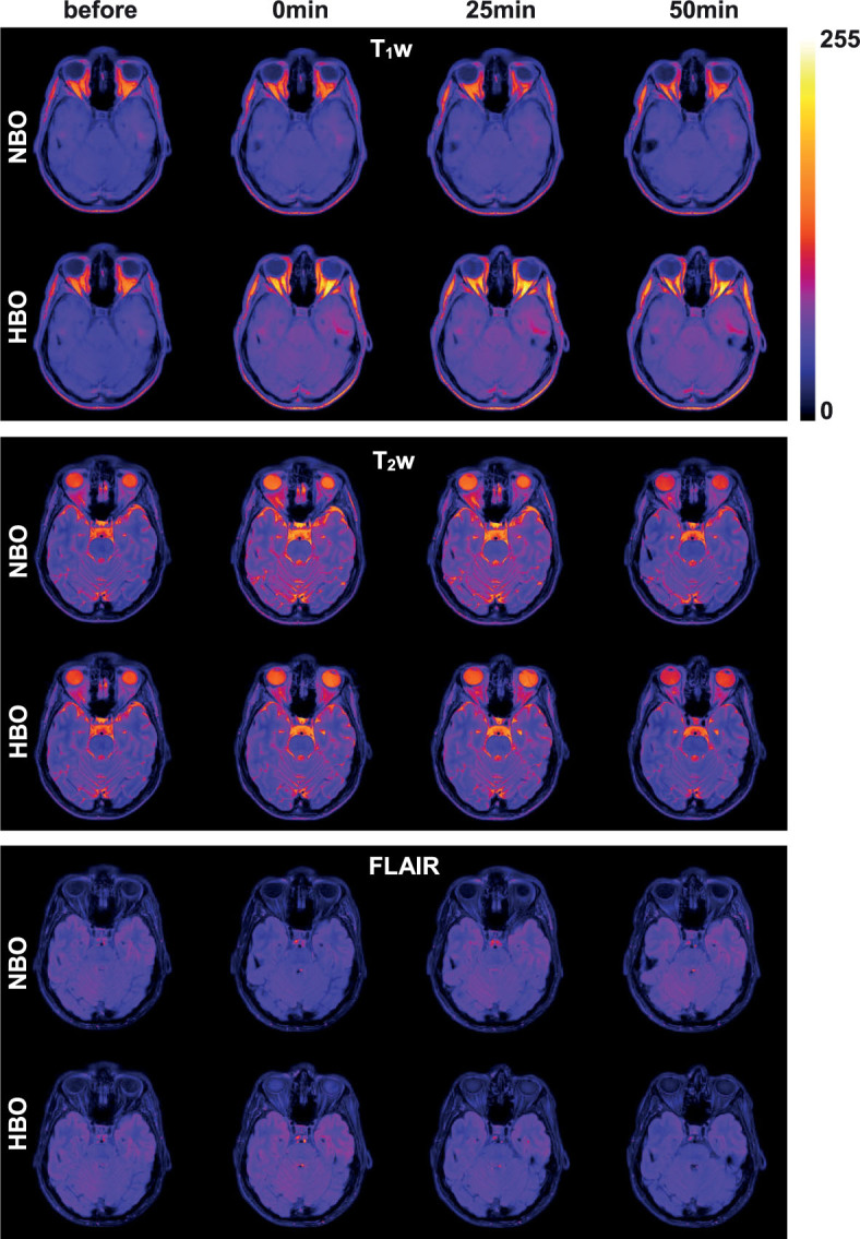 The effects of normobaric and hyperbaric oxygenation on MRI signal intensities in <i>T<sub>1</sub></i> -weighted, <i>T<sub>2</sub></i> -weighted and FLAIR images in human brain.