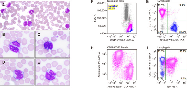 Persistent polyclonal B-cell lymphocytosis with buttock-like cells mimicking follicular lymphoma.