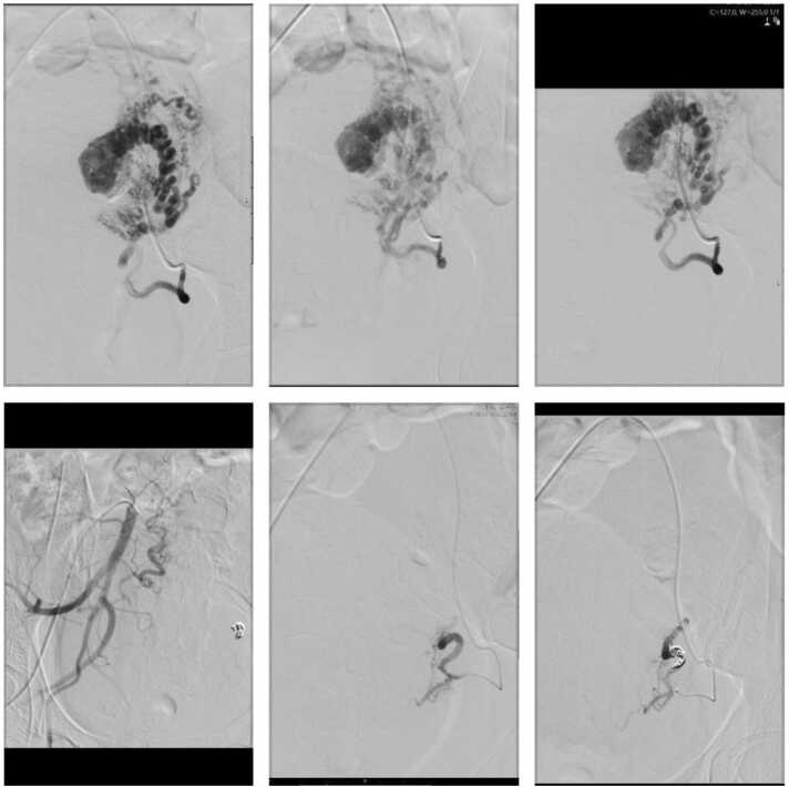 Uterine venous malformations in the puerperium: 2 Atypical cases and literature review