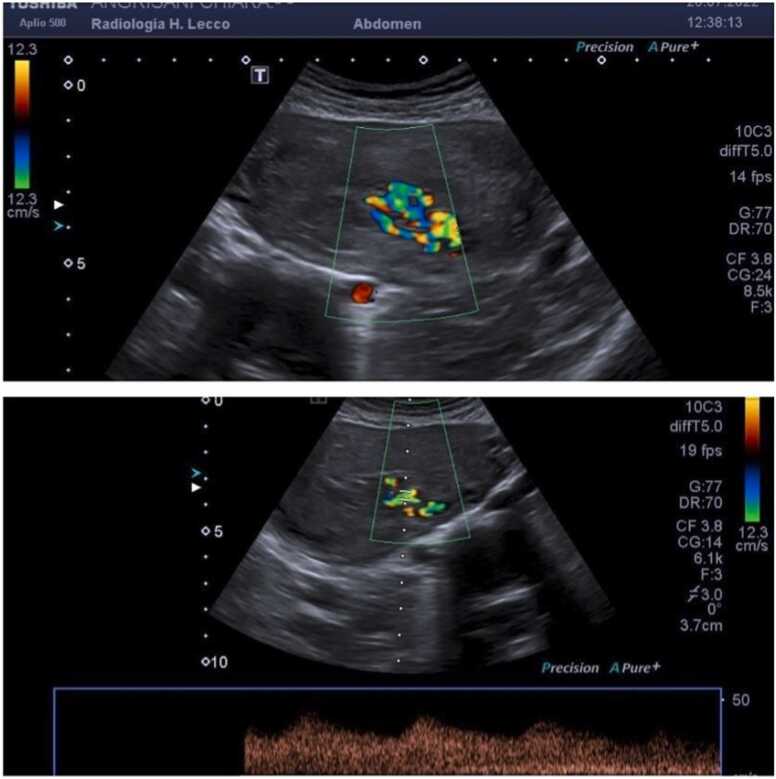 Uterine venous malformations in the puerperium: 2 Atypical cases and literature review