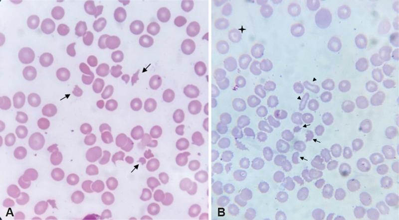 Traversing Their Path to the Peripheral Smear: The Journey of Traumatized Red Blood Cells.