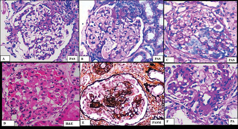 A Study of Focal and Segmental Glomerulosclerosis according to the Columbia Classification and Its Correlation with the Clinical Outcome.