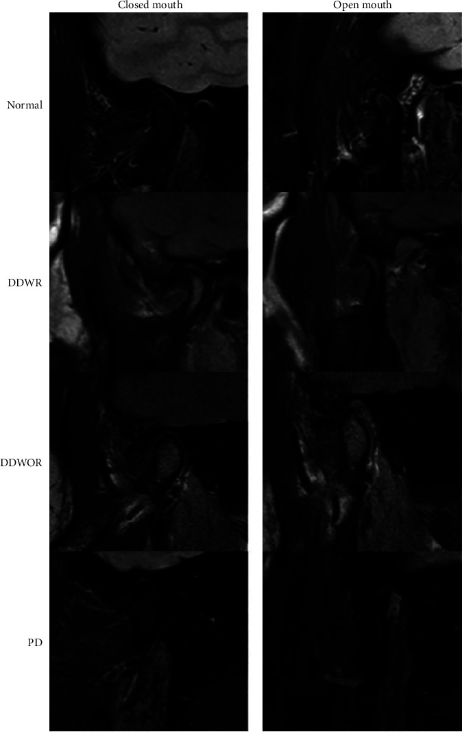 Relation between Condyle Horizontal Angle and Intercondylar Angle with Disc Displacement in Patients with Temporomandibular Joint Disorders: An MRI Evaluation.