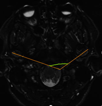 Relation between Condyle Horizontal Angle and Intercondylar Angle with Disc Displacement in Patients with Temporomandibular Joint Disorders: An MRI Evaluation.