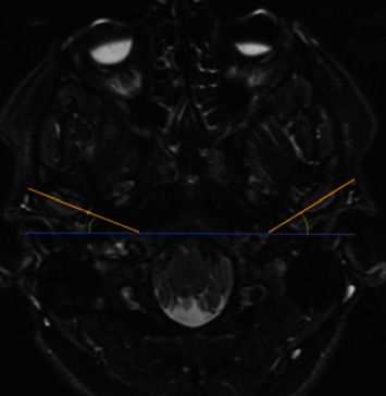 Relation between Condyle Horizontal Angle and Intercondylar Angle with Disc Displacement in Patients with Temporomandibular Joint Disorders: An MRI Evaluation.