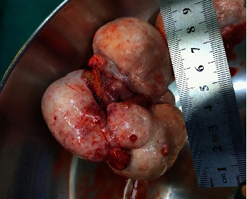 Fertility-Preserving Surgery in a Young Nulligravid Woman with Bilateral Coexistence of a Granulosa Cell Tumor with a Teratoma.