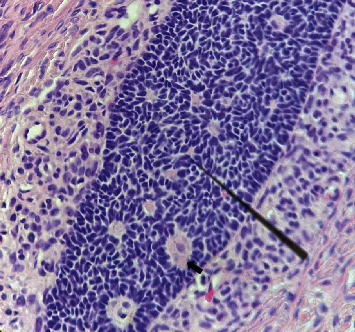 Fertility-Preserving Surgery in a Young Nulligravid Woman with Bilateral Coexistence of a Granulosa Cell Tumor with a Teratoma.