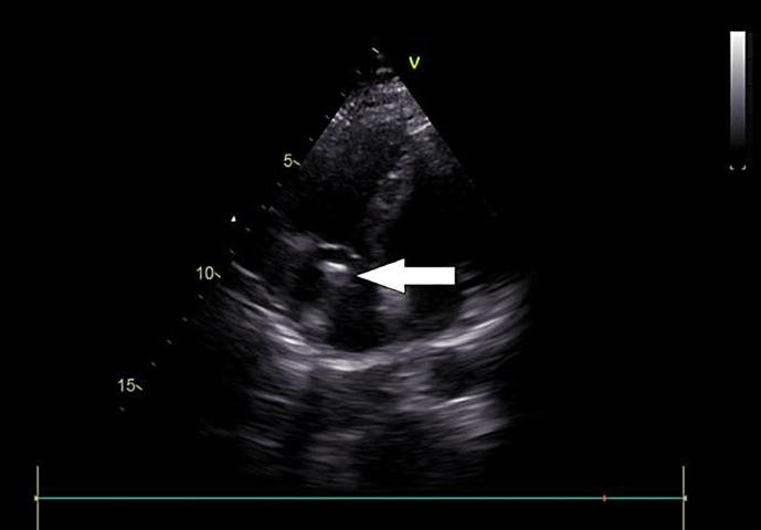 Catheter-Related Bloodstream Infection in Hemodialysis Patient due to <i>Atlantibacter hermannii</i>.