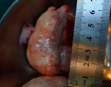 Fertility-Preserving Surgery in a Young Nulligravid Woman with Bilateral Coexistence of a Granulosa Cell Tumor with a Teratoma.