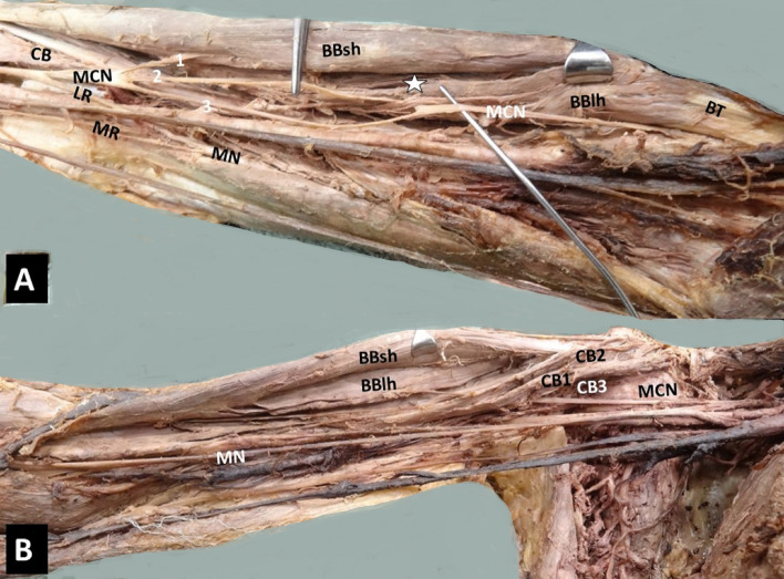 Coracobrachialis muscle morphology and coexisted neural variants: a cadaveric case series.