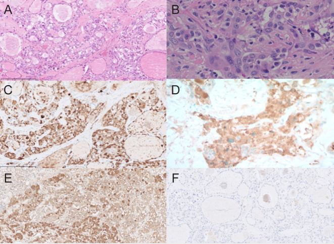 Ectopic Cushing's syndrome from a corticotropin-releasing hormone-secreting medullary thyroid carcinoma: a rare pitfall of inferior petrosal sinus sampling.