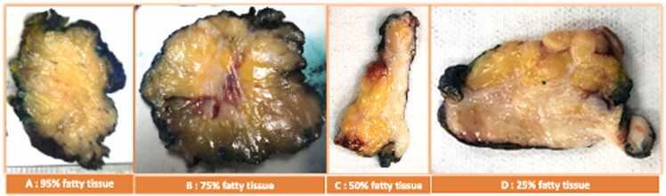 Pathological macroscopic evaluation of breast density versus mammographic breast density in breast cancer conserving surgery