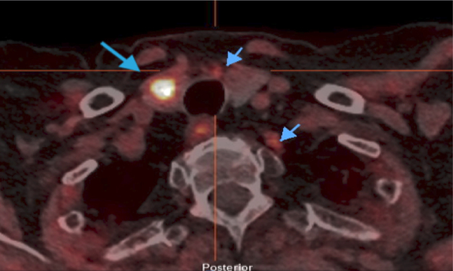 Ectopic Cushing's syndrome from a corticotropin-releasing hormone-secreting medullary thyroid carcinoma: a rare pitfall of inferior petrosal sinus sampling.