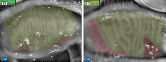 The Effects of Blepharoptosis Surgery on Meibomian Gland, Tear Film, and Corneal Topography.