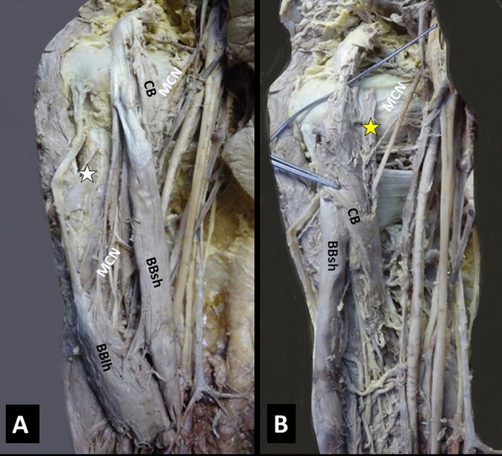 Coracobrachialis muscle morphology and coexisted neural variants: a cadaveric case series.