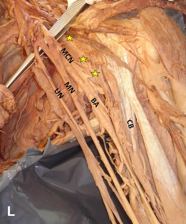 Coracobrachialis muscle morphology and coexisted neural variants: a cadaveric case series.