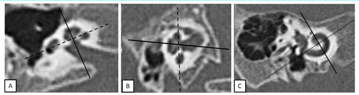 The Cochlear Size Variations in Incomplete Partitions with Multiplanar Images on Pediatric Temporal Bone CT.