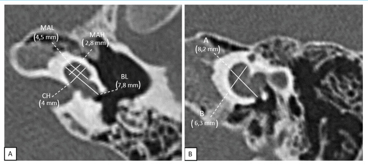 The Cochlear Size Variations in Incomplete Partitions with Multiplanar Images on Pediatric Temporal Bone CT.