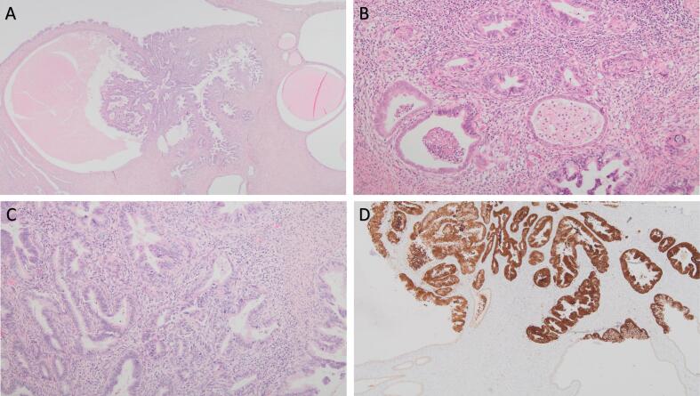 Isolated tubal metastasis from an incidental HPV-associated endocervical adenocarcinoma presented as an adnexal mass: A case report