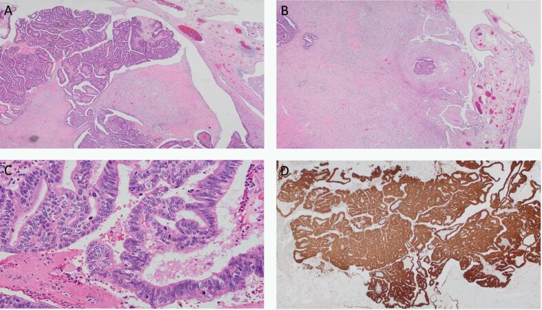 Isolated tubal metastasis from an incidental HPV-associated endocervical adenocarcinoma presented as an adnexal mass: A case report