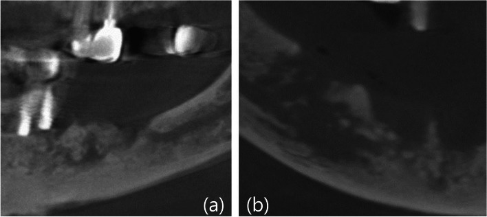 A clinical retrospective study of implant as a risk factor for medication-related osteonecrosis of the jaw: surgery vs loading?