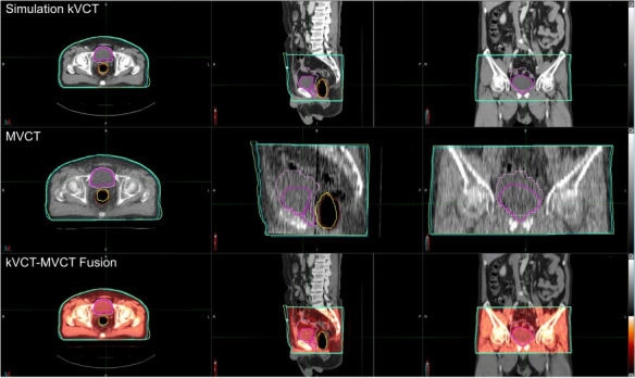 Feasibility of artificial intelligence-driven interfractional monitoring of organ changes by mega-voltage computed tomography in intensity-modulated radiotherapy of prostate cancer.