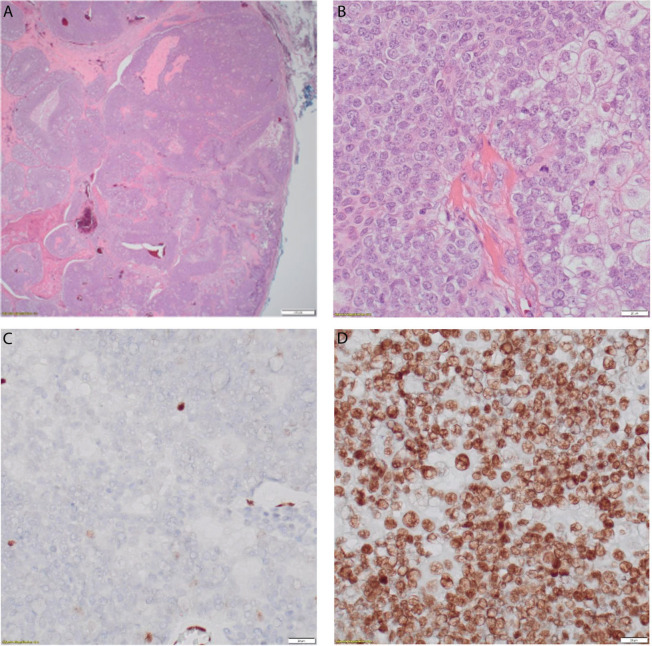 Looking beyond the surface: Muir Torre syndrome.