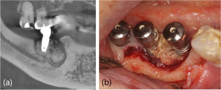 A clinical retrospective study of implant as a risk factor for medication-related osteonecrosis of the jaw: surgery vs loading?