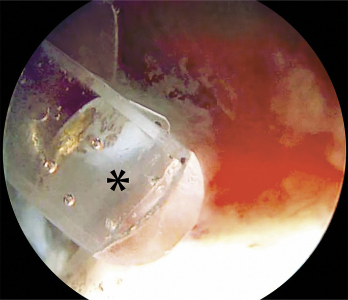 Labral Reconstruction via Capsular Augmentation Maintains Perfusion to the Acetabular Labrum and Locally Transferred Autograft: An in Vivo Laser Doppler Flowmetry Analysis.