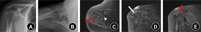 Transient postoperative inferior subluxation of the shoulder after surgical stabilization of recurrent anterior dislocation in a patient with myasthenia gravis: a case report.