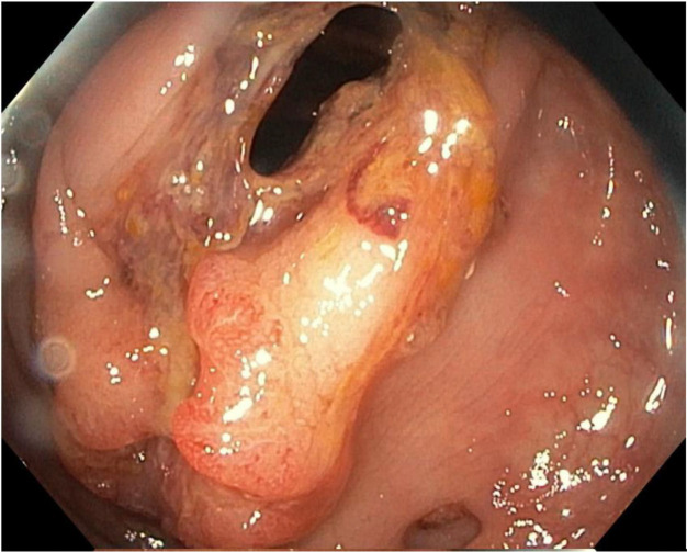 Looking beyond the surface: Muir Torre syndrome.