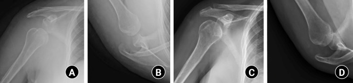 Transient postoperative inferior subluxation of the shoulder after surgical stabilization of recurrent anterior dislocation in a patient with myasthenia gravis: a case report.