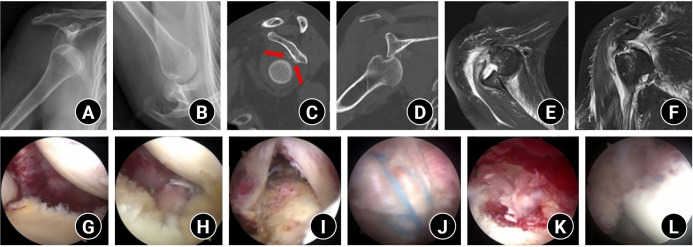 Transient postoperative inferior subluxation of the shoulder after surgical stabilization of recurrent anterior dislocation in a patient with myasthenia gravis: a case report.