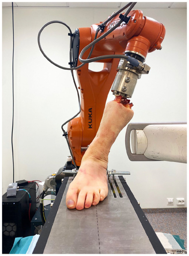 Effects of Progressive Deltoid Ligament Sectioning on Weber B Ankle Fracture Stability.