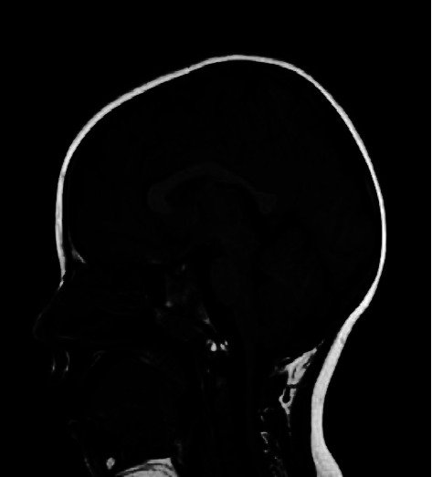 Behavioral Phenotype, Electroclinical Features, and Treatment Options in Twins with <i>Lrp2</i> Candidate Variants (Donnay-Barrow/Foar Syndrome).