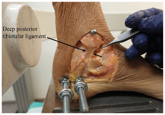 Effects of Progressive Deltoid Ligament Sectioning on Weber B Ankle Fracture Stability.