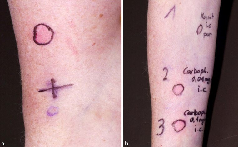 Anaphylactic reaction to carboplatin diagnosed by skin testing-a reliable tool in platinum-based immediate-type hypersensitivity reactions.