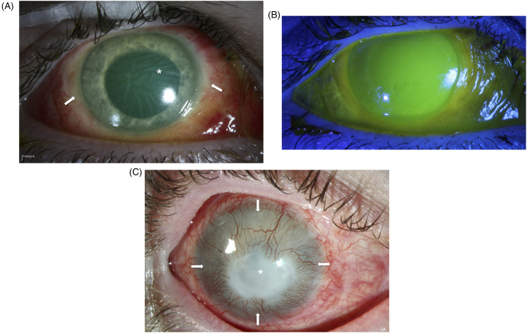 Severe chemical eye injuries - clinical outcomes and associated socio-economic factors.