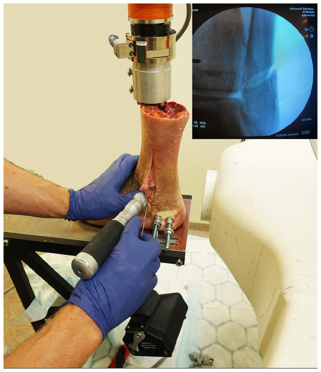 Effects of Progressive Deltoid Ligament Sectioning on Weber B Ankle Fracture Stability.