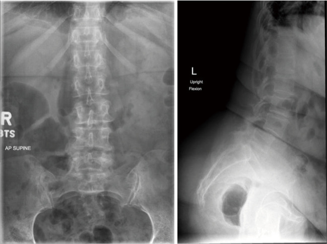 Prone position lateral interbody fusion-a narrative review.