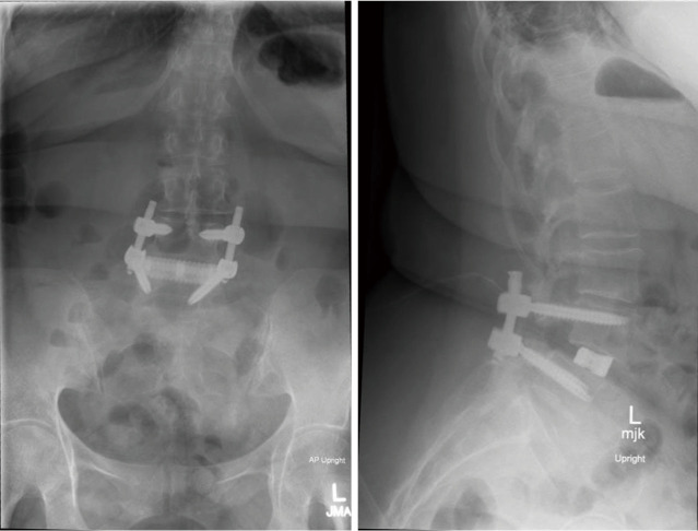 Prone position lateral interbody fusion-a narrative review.