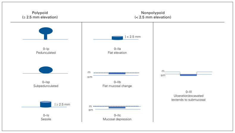 Colorectal polyp classification and management of complex polyps for surgeon endoscopists.