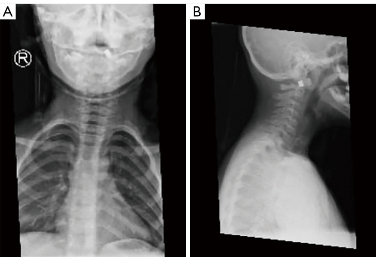 Air-gun pellet at C1: a case report and literature review.