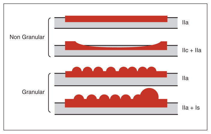 Colorectal polyp classification and management of complex polyps for surgeon endoscopists.